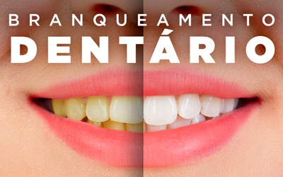 BRANQUEAMENTO DENTÁRIO