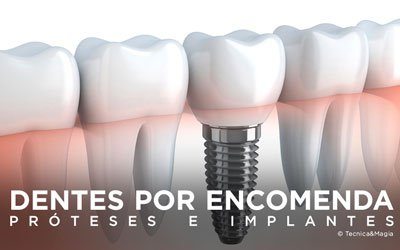 DENTES POR ENCOMENDA: IMPLANTES E PRÓTESES