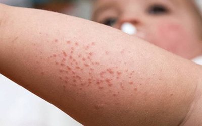 Eczema em idade pediátrica associado a outras alergias