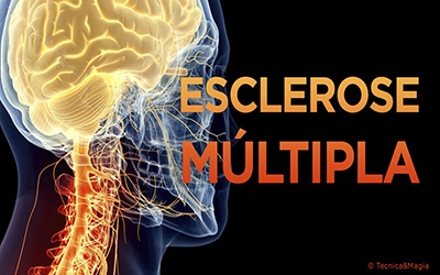 ESCLEROSE MÚLTIPLA