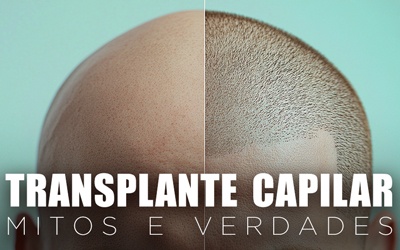 TRANSPLANTE CAPILAR: MITOS E VERDADES