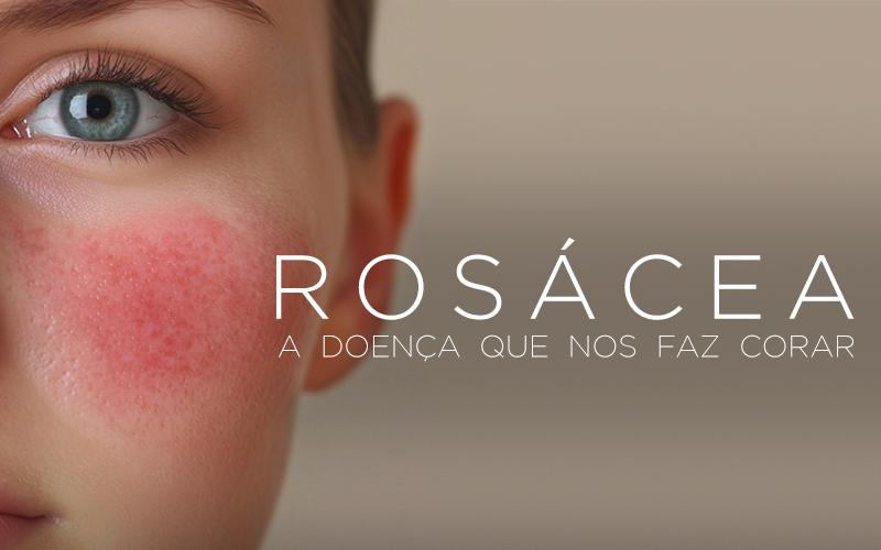 ROSÁCEA: A DOENÇA QUE NOS FAZ CORAR