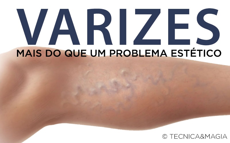 VARIZES - Mais do que um problema estético