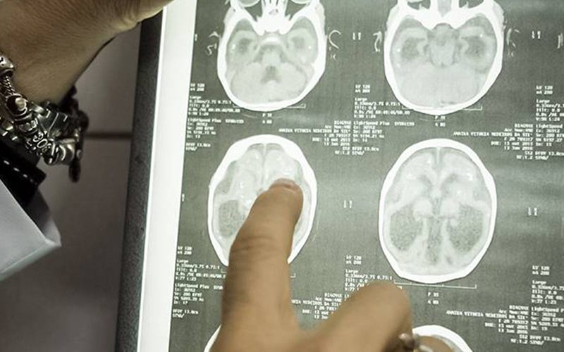 Vírus Zika eficaz contra células de cancro cerebral em adultos