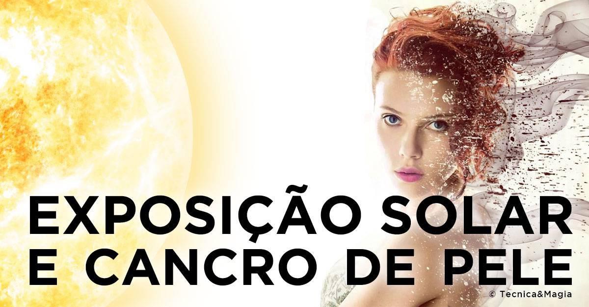 EXPOSIÇÃO SOLAR E O CANCRO DA PELE