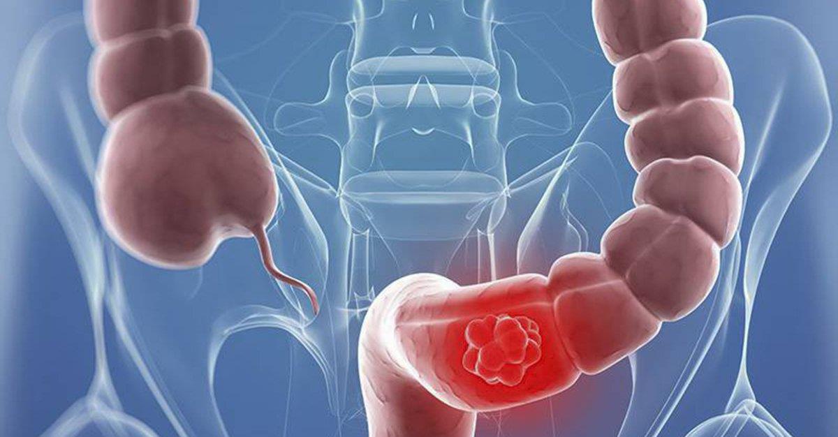 Europacolon aconselha rastreios ao cancro colorretal a partir dos 50 anos