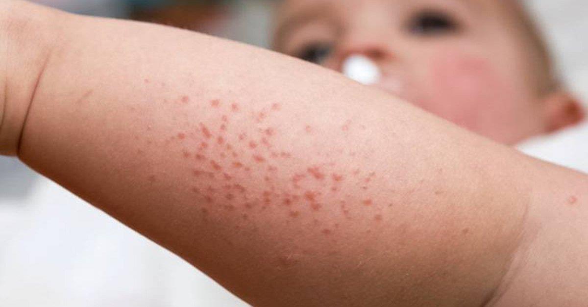 Eczema em idade pediátrica associado a outras alergias