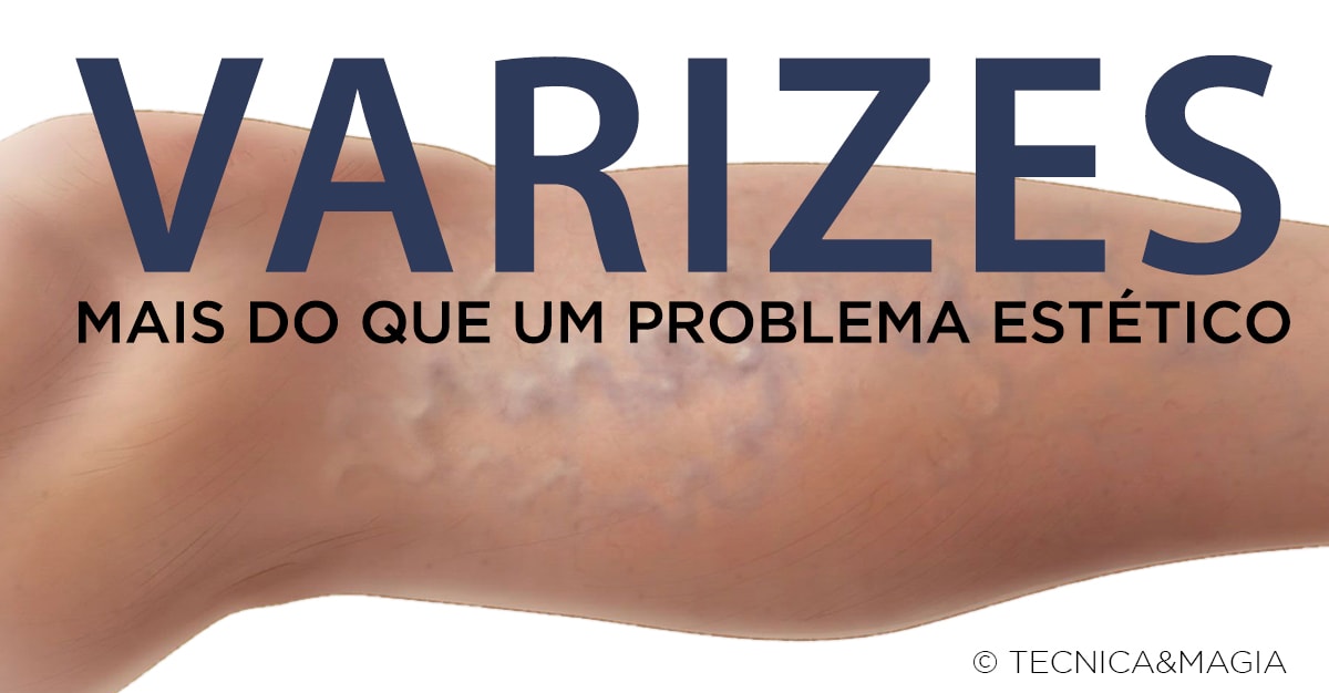 VARIZES - Mais do que um problema estético