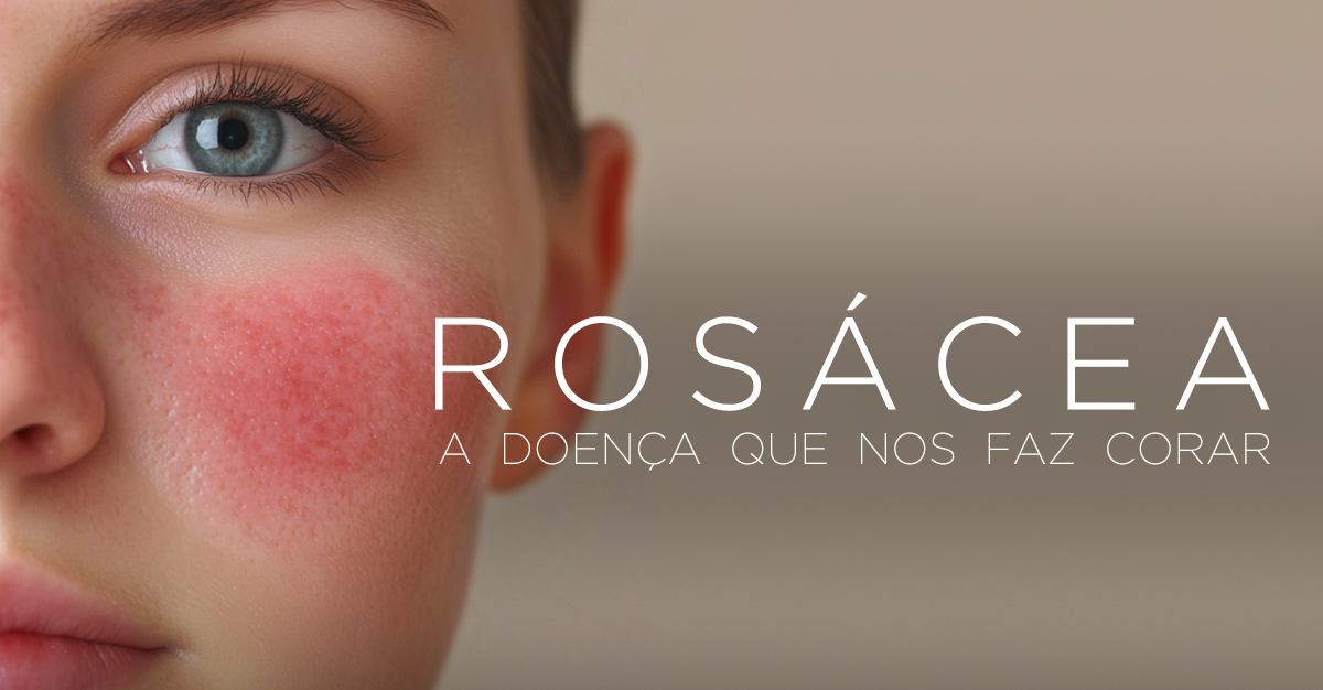 ROSÁCEA: A DOENÇA QUE NOS FAZ CORAR