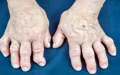 Artrite psoriática: descoberta nova forma de diminuir progressão