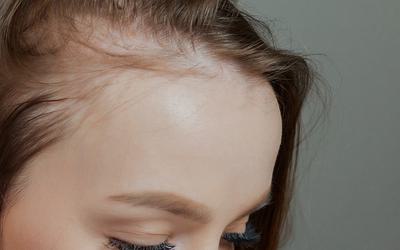 Pílula anticoncecional pode contribuir para alopecia cicatricial