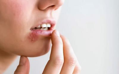Herpes labial é mais comum no verão: saiba porquê e como prevenir