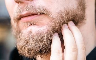 Caspa na barba: descubra as causas e soluções