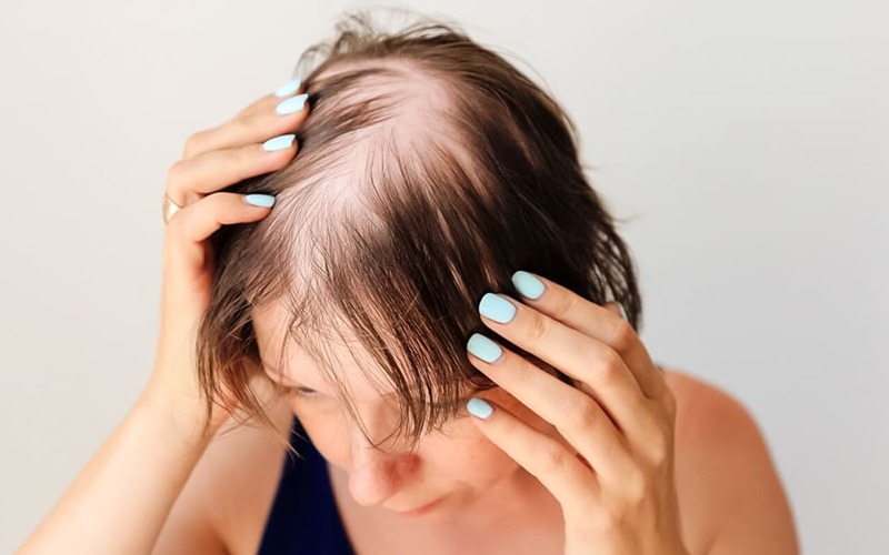 Estudo revela nova opção para adultos com alopecia areata grave